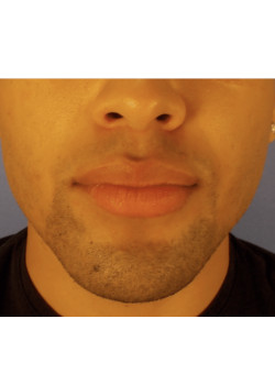 LIPOSUCTION/JAW LINE