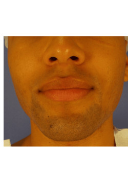 LIPOSUCTION/JAW LINE