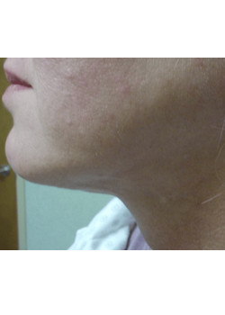 LIPOSUCTION/CHIN/FACETITE
