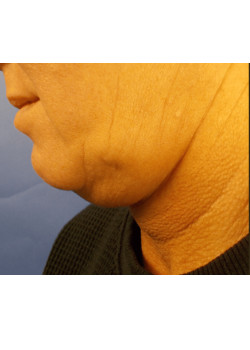 LIPOSUCTION/CHIN/FACETITE