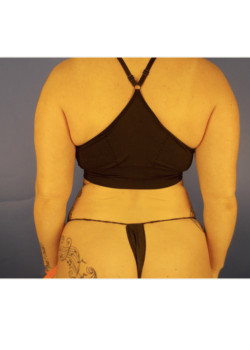 LIPOSUCTION / BODYTITE