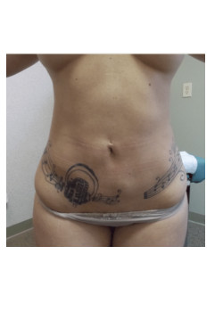 LIPOSUCTION 360 / BODYTITE