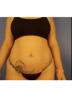 LIPOSUCTION 360 / BODYTITE