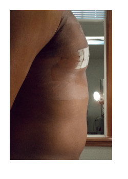 LIPOSUCTION / BODYTITE