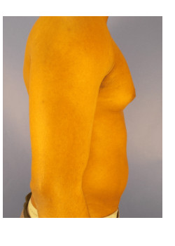 LIPOSUCTION / BODYTITE