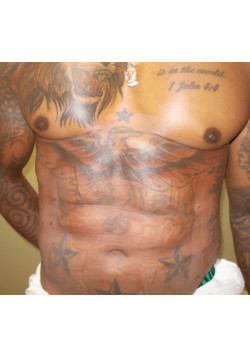 LIPOSUCTION/ BODYTITE/GYNECOMASTIA