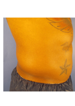 LIPOSUCTION/ BODYTITE/GYNECOMASTIA
