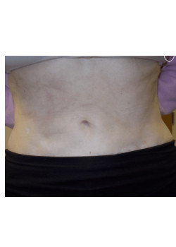 LIPOSUCTION