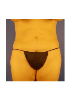 LIPOSUCTION