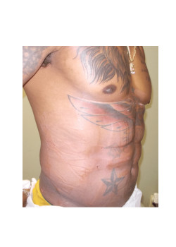 LIPOSUCTION / BODYTITE /GYNECOMASTIA