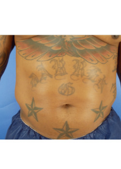 LIPOSUCTION / BODYTITE /GYNECOMASTIA