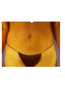 LIPOSUCTION