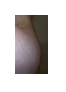 LIPOSUCTION FOR BUFFALO HUMP