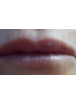 RESTYLANE LIP FILLER