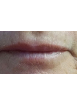 RESTYLANE LIP FILLER