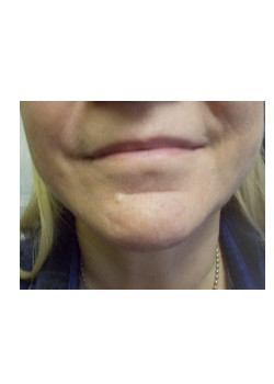 Facetite and liposuction of  chin, neck and jowls