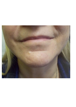 Liposuction and Facetite of chin neck and jowls