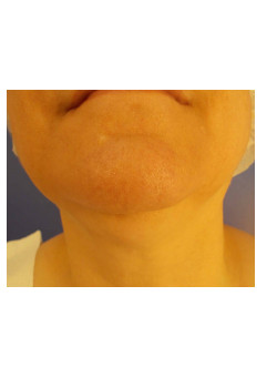 Liposuction and Facetite of chin neck and jowls
