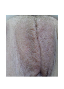 Labiaplasty