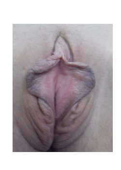 Labiaplasty