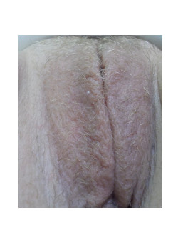Labiaplasty