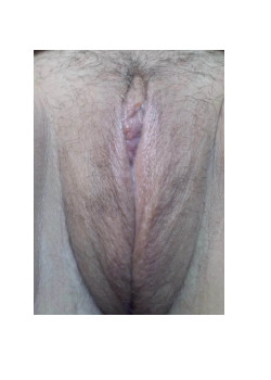 Labiaplasty