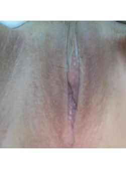 Labiaplasty