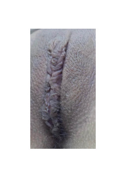 Labiaplasty