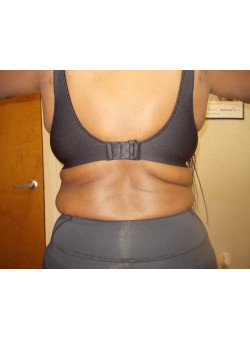 Liposuction of back