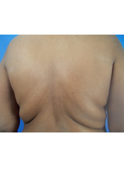Liposuction of back